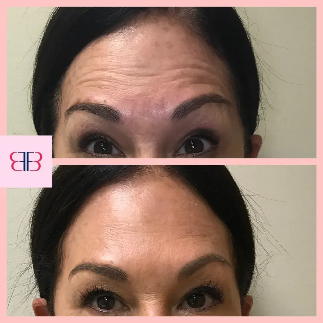 botox forehead lines before and after