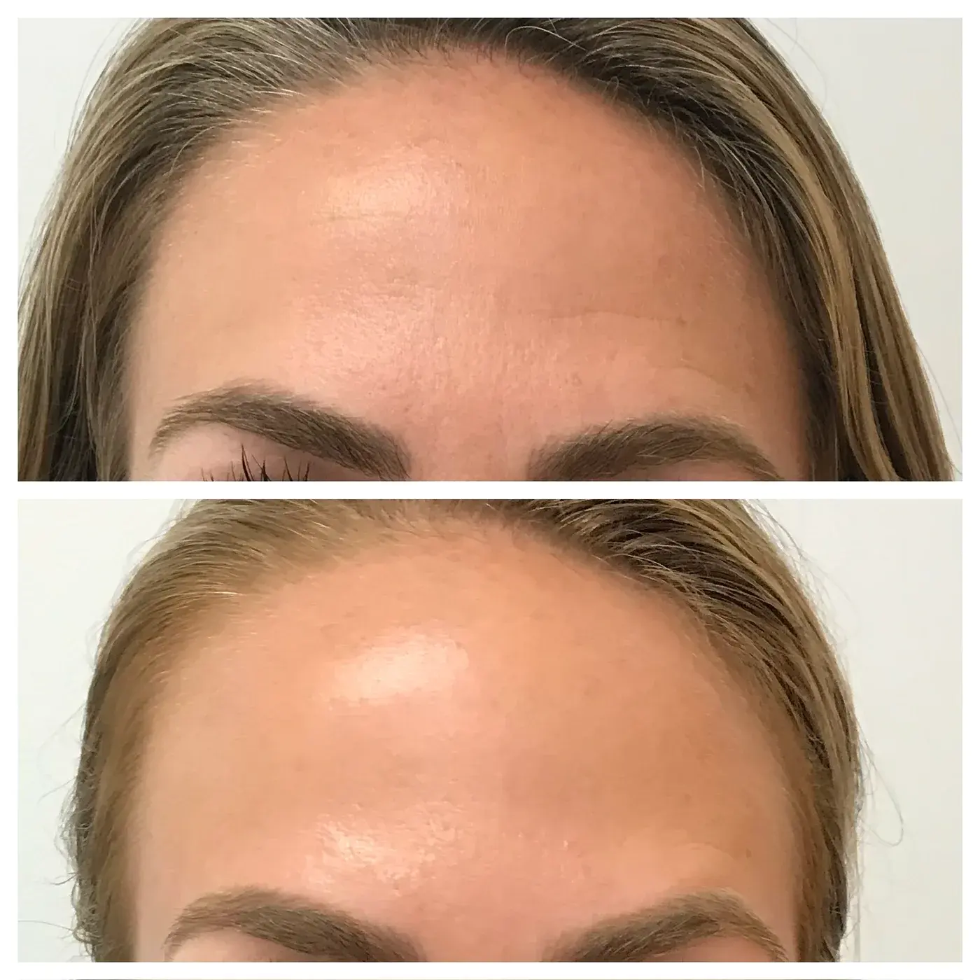 botox forehead lines before and after