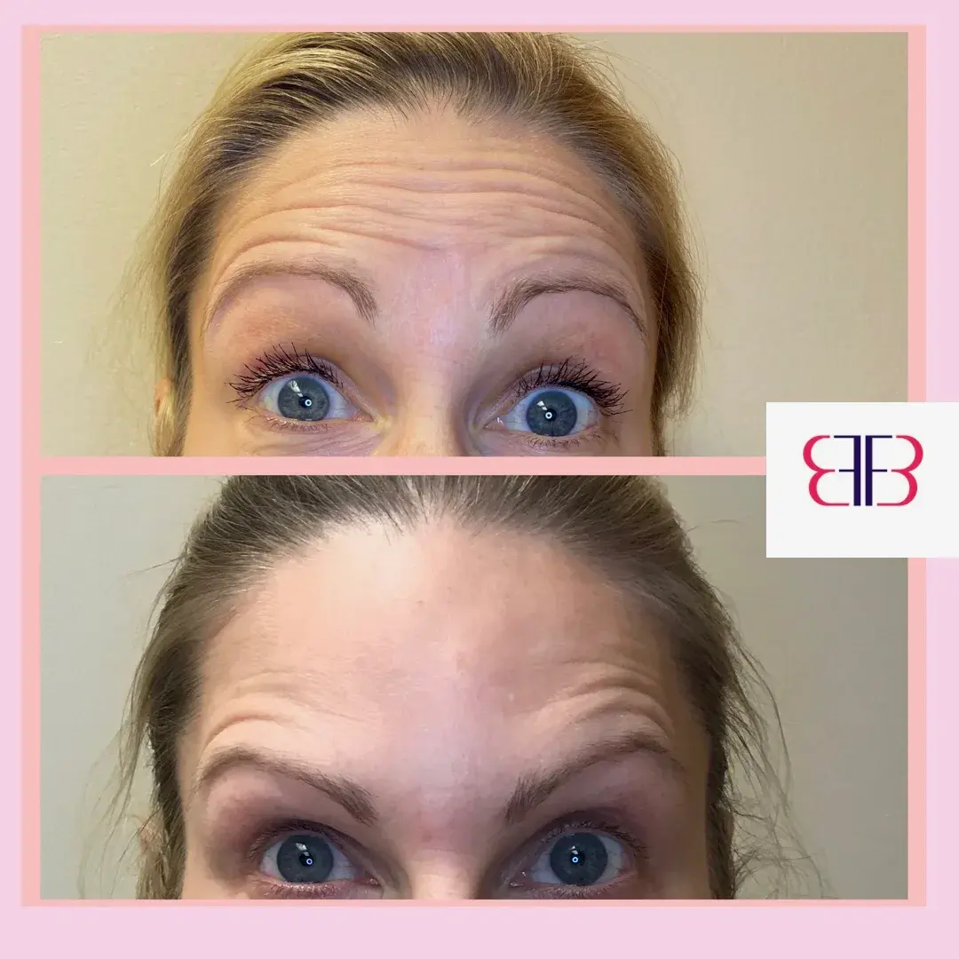 botox forehead lines before and after