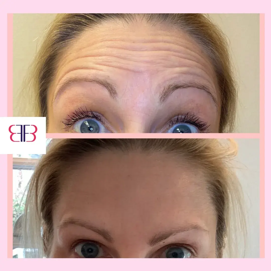 botox forehead lines before and after