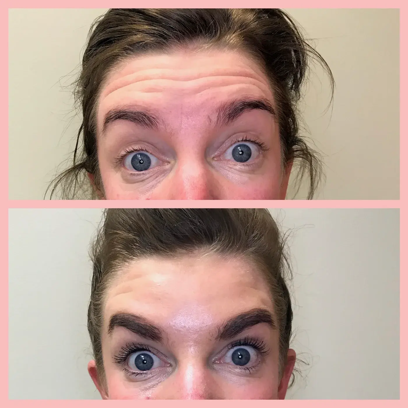 botox forehead lines before and after