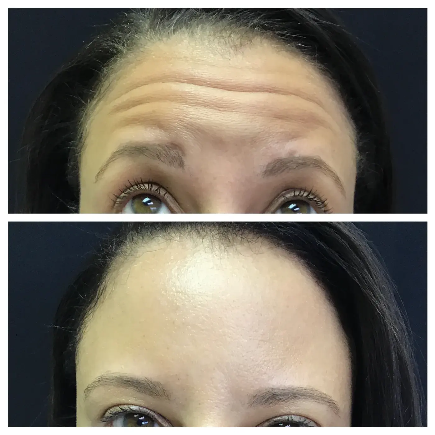 botox forehead lines before and after