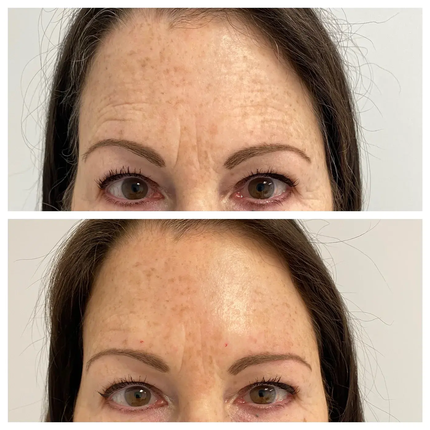 botox forehead lines before and after