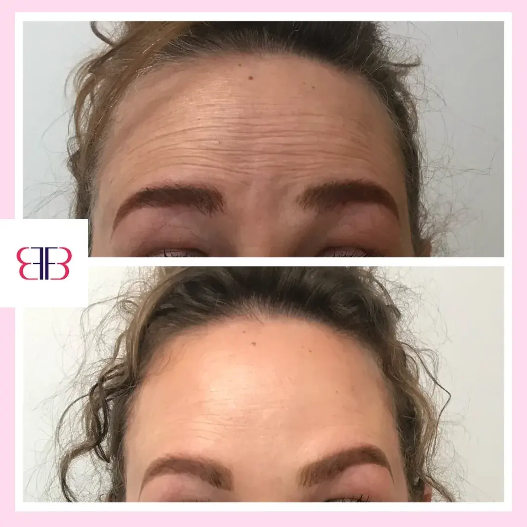 botox forehead lines before and after