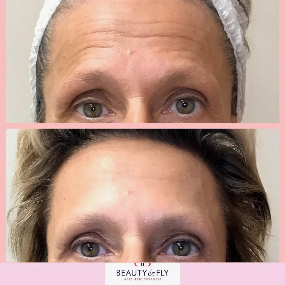 botox forehead lines before and after