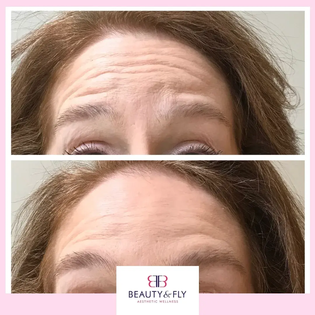 botox forehead lines before and after