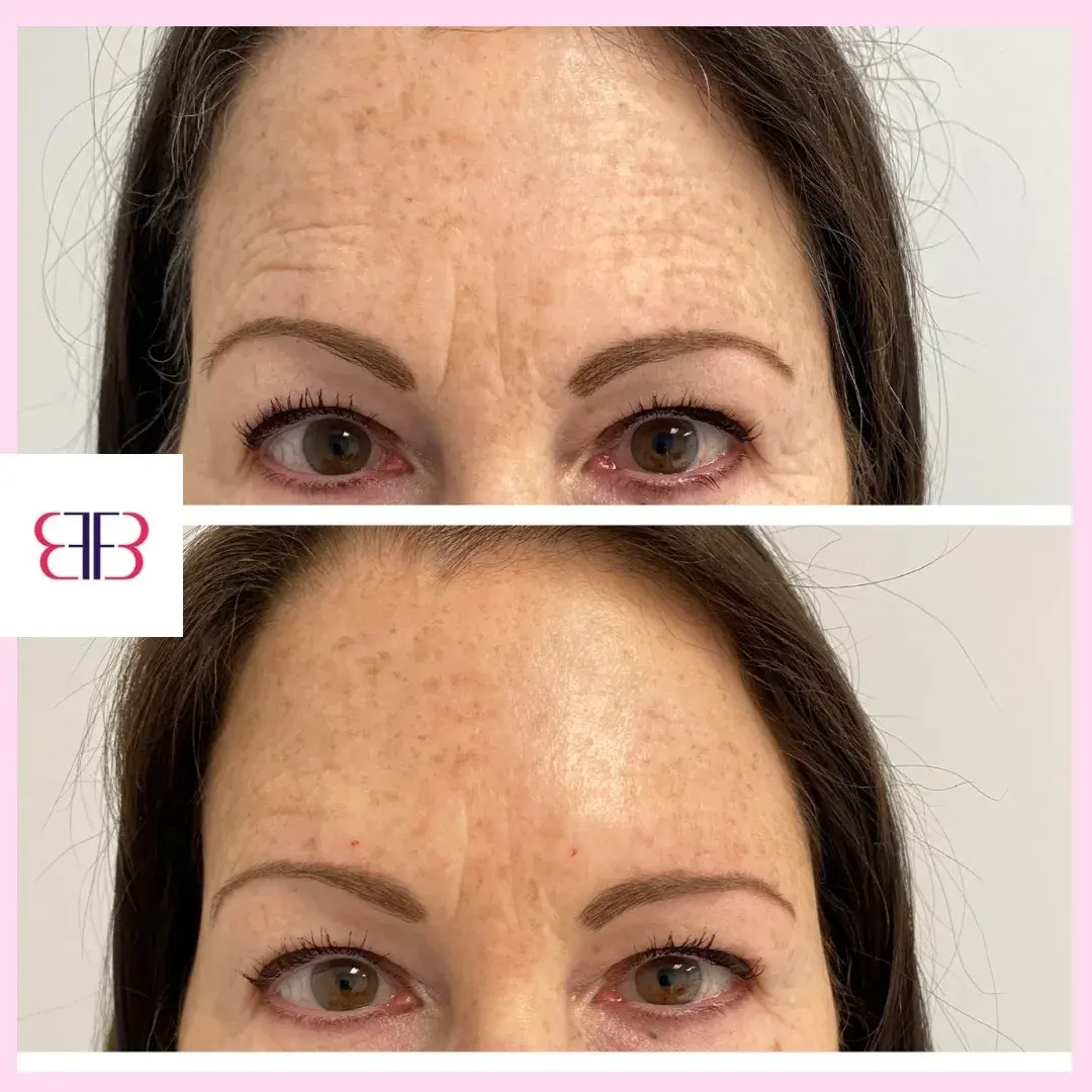 botox forehead lines before and after