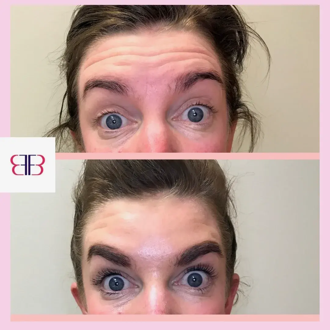 botox forehead lines before and after
