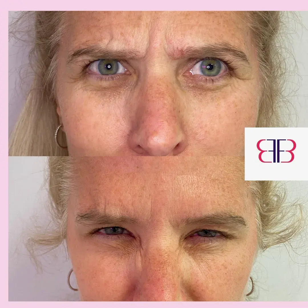 botox frown lines before and after