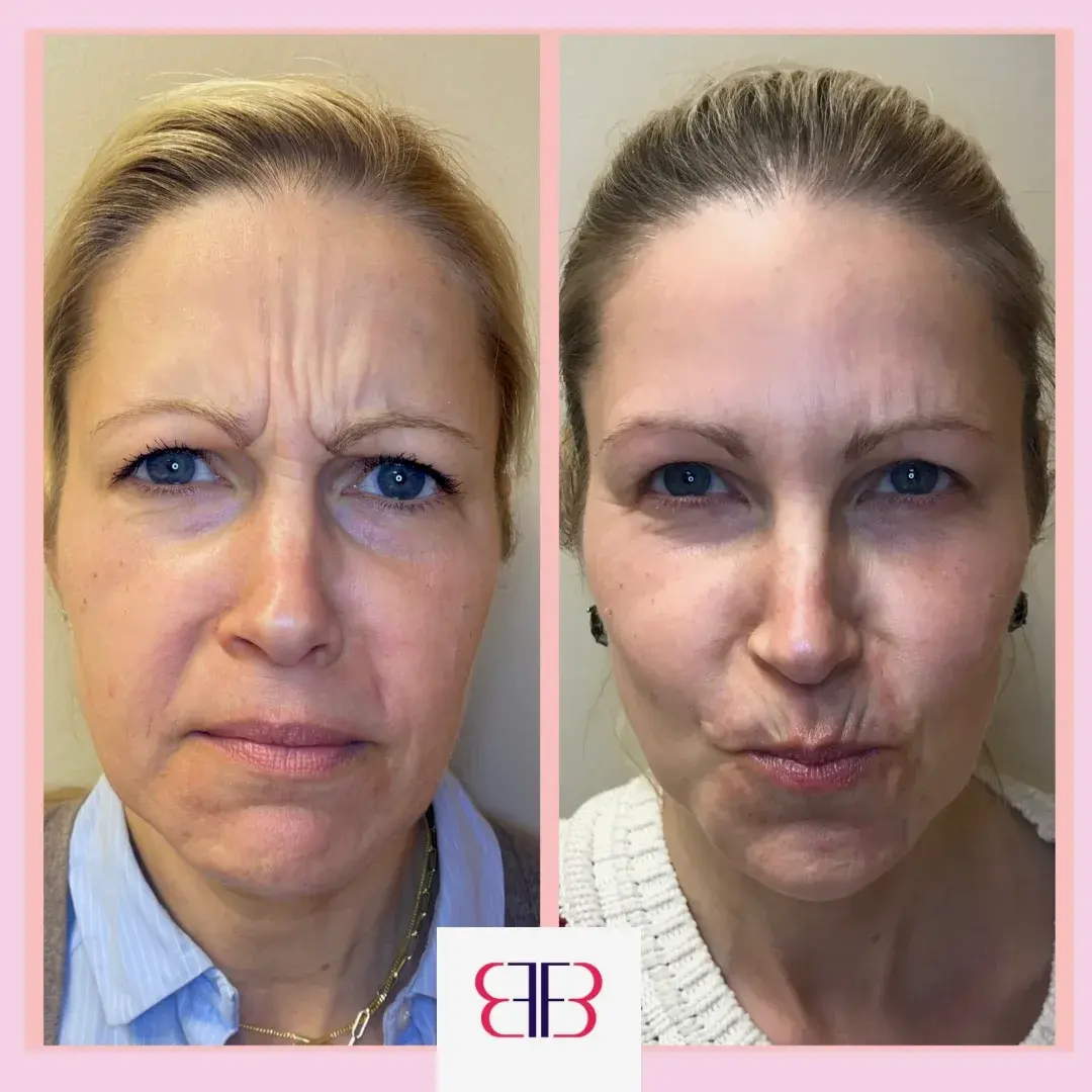 botox frown lines before and after