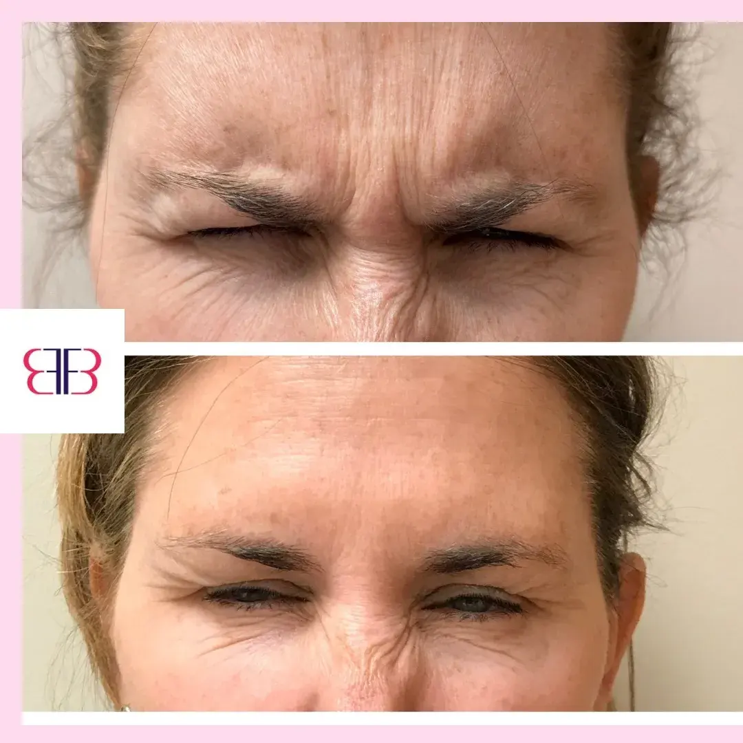 botox frown lines before and after