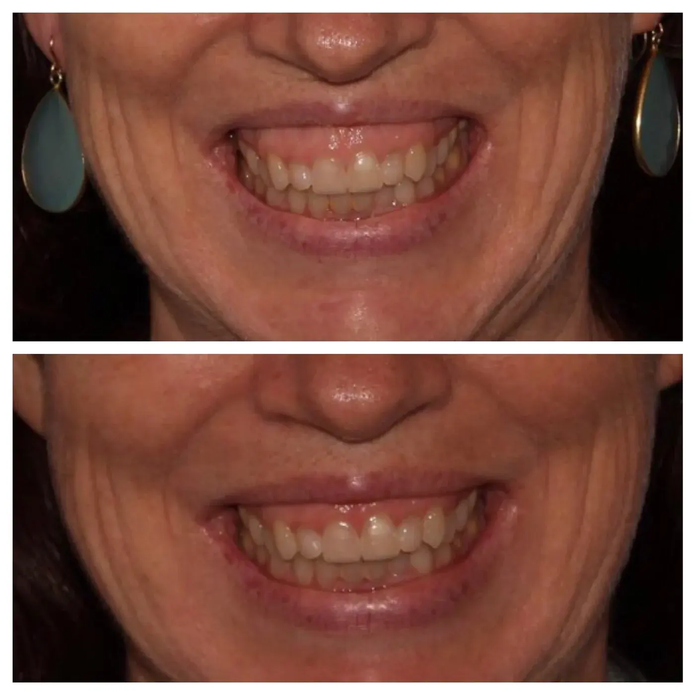 gummy smile before and after
