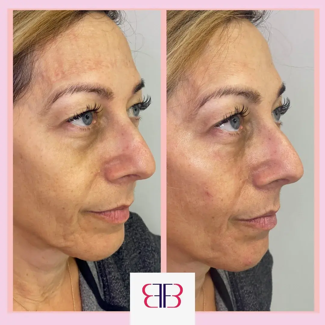 cheek filler before and after