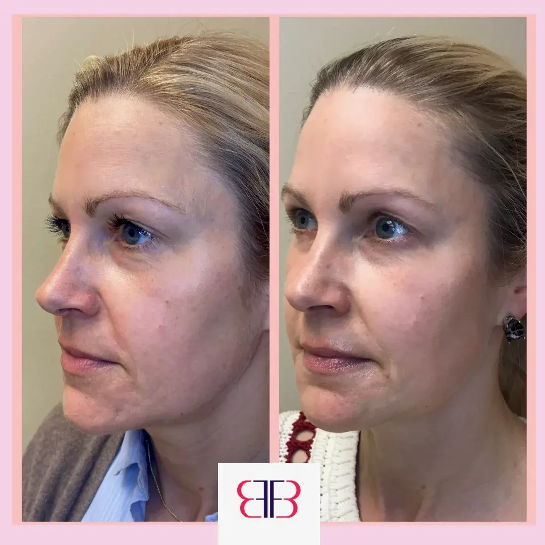cheek filler before and after