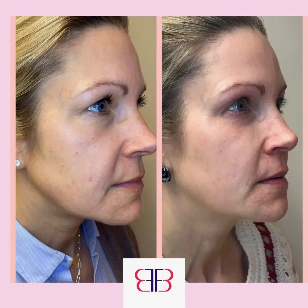 cheek filler before and after