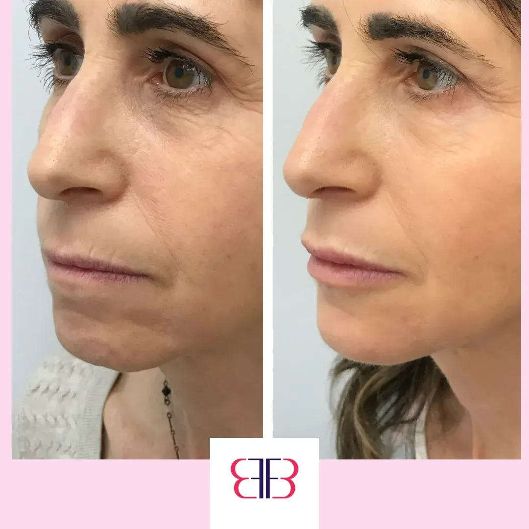 cheek filler before and after
