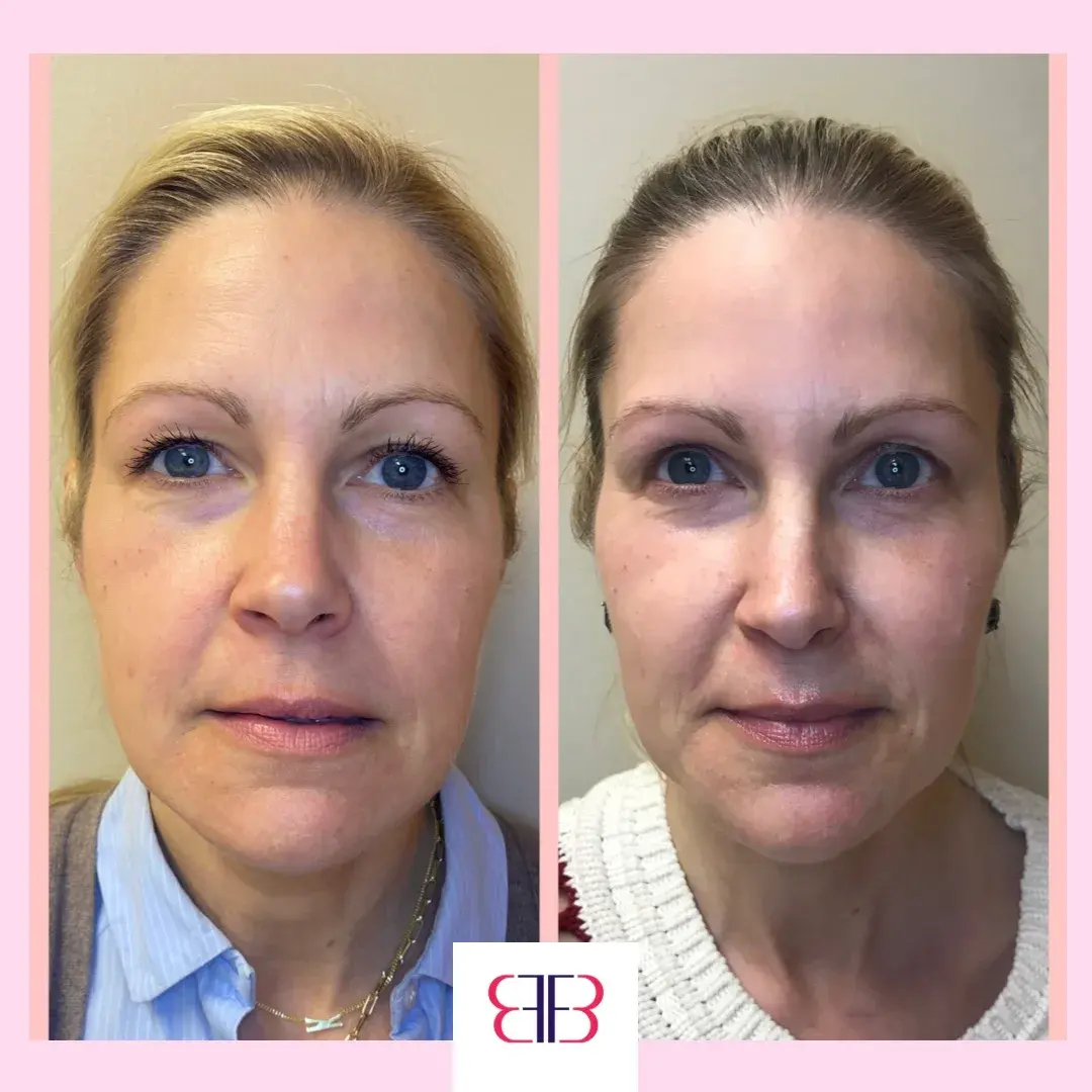 full face filler before and after