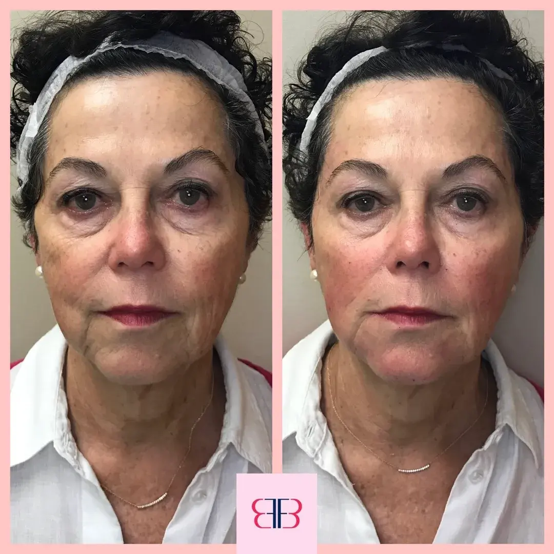 full face filler before and after
