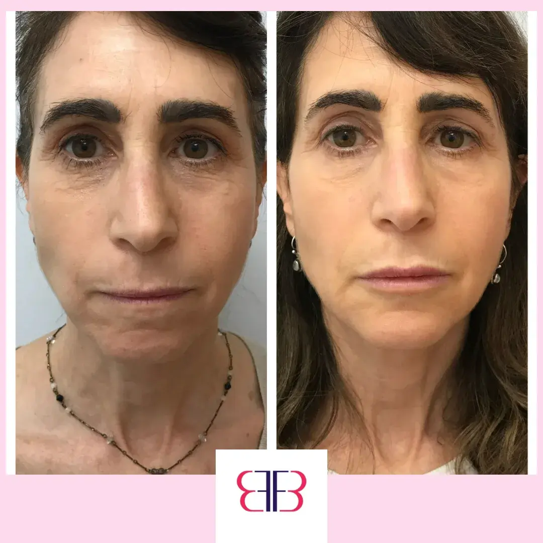full face filler before and after