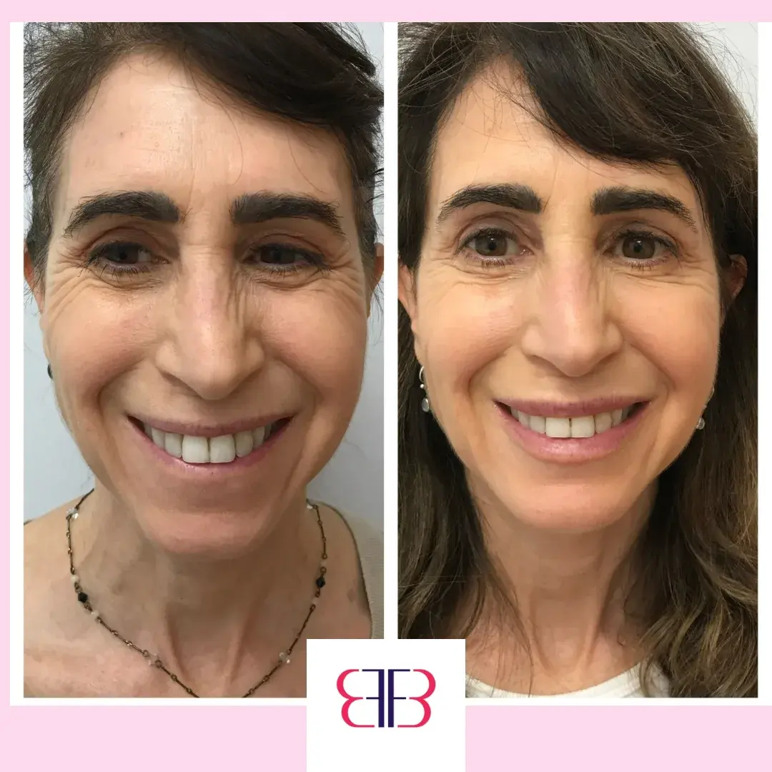 full face filler before and after
