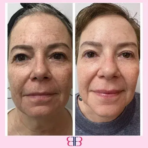 full face filler before and after