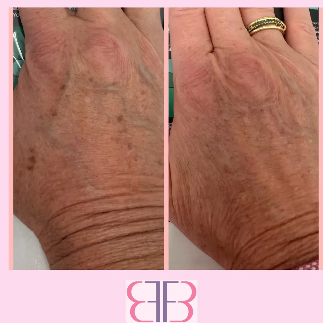 hand rejuvenation before and after