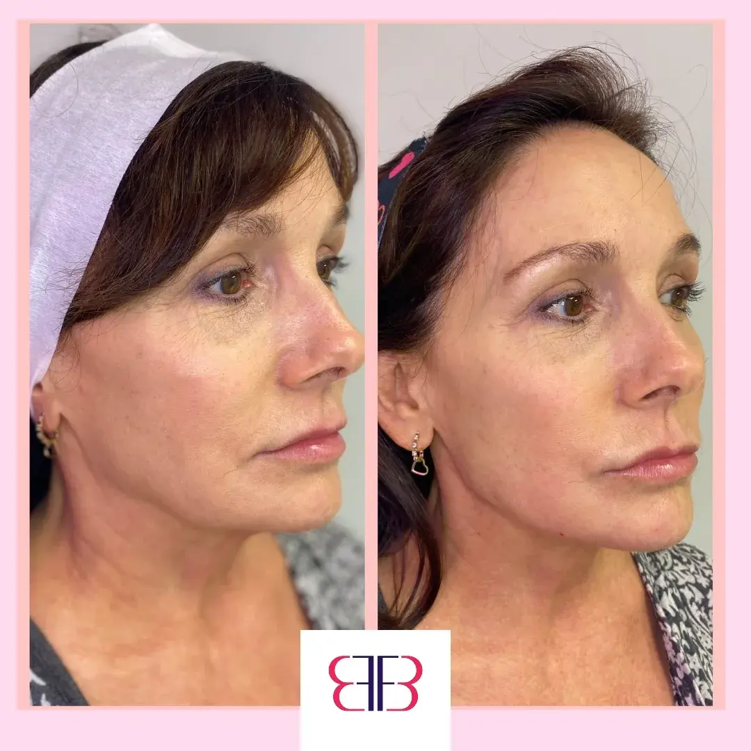 jawline filler before and after