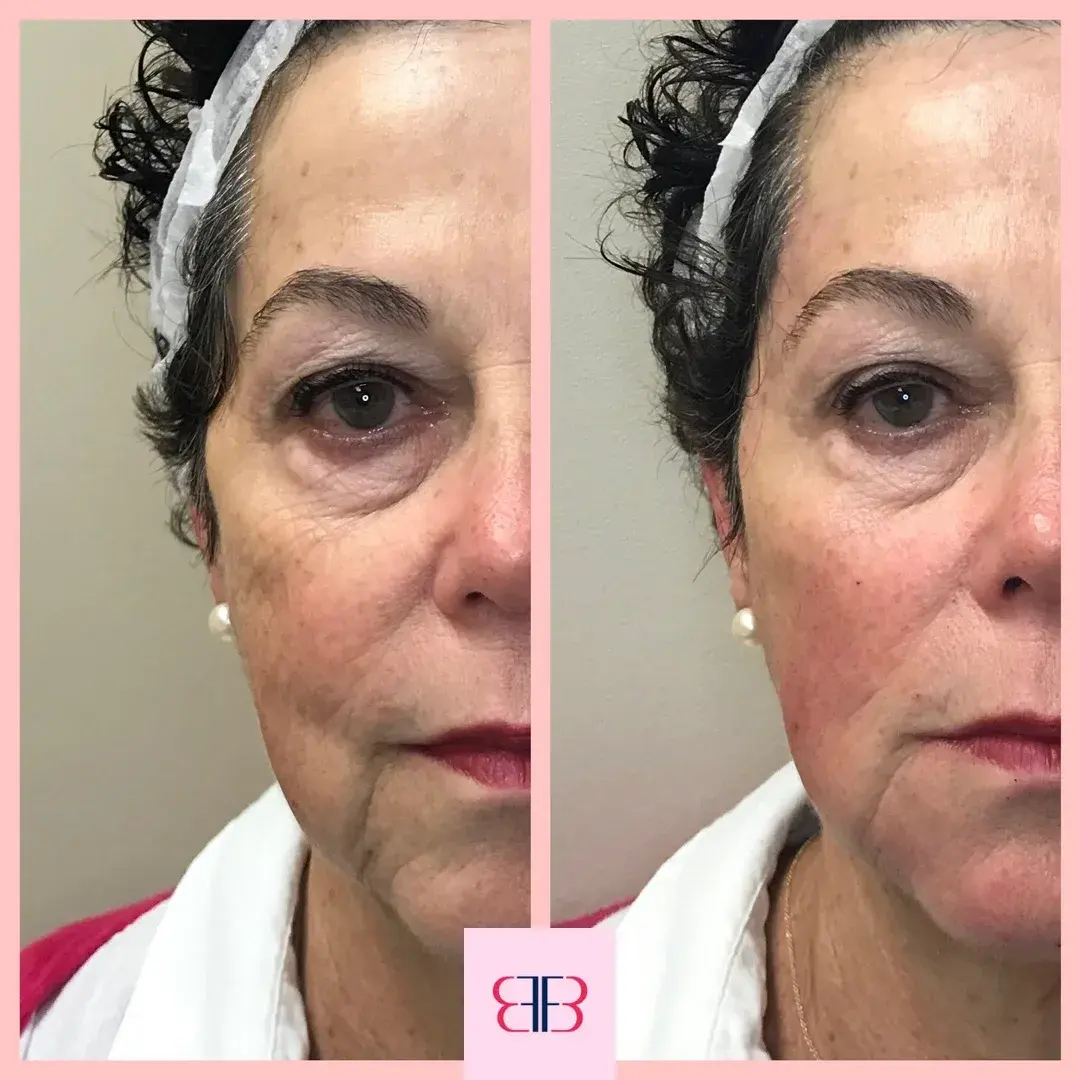 jawline filler before and after