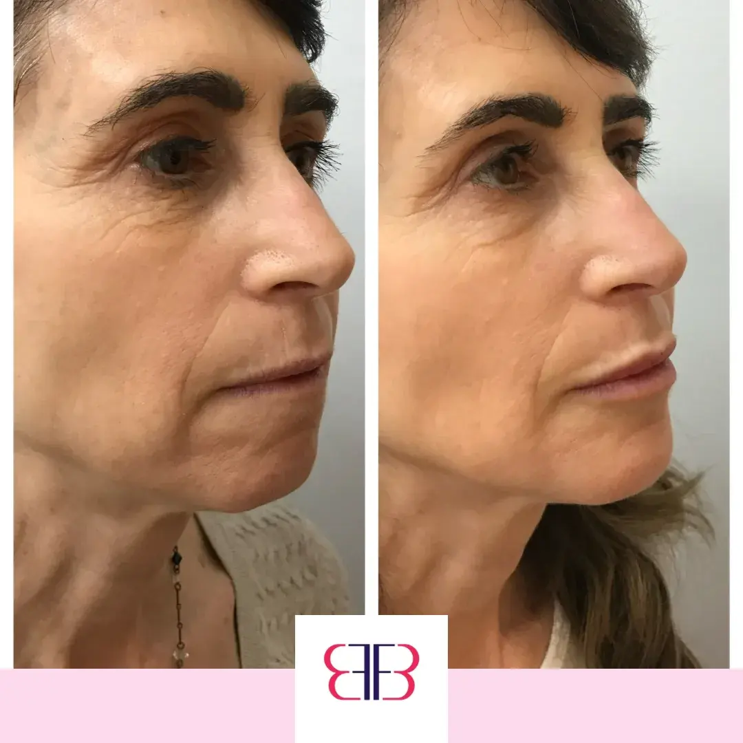 jawline filler before and after