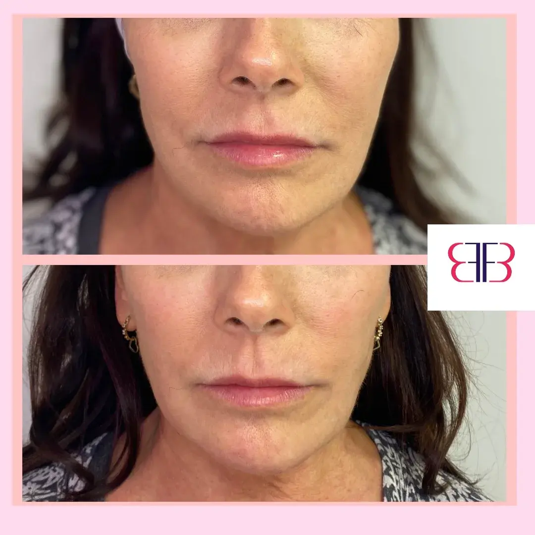 lip filler before and after