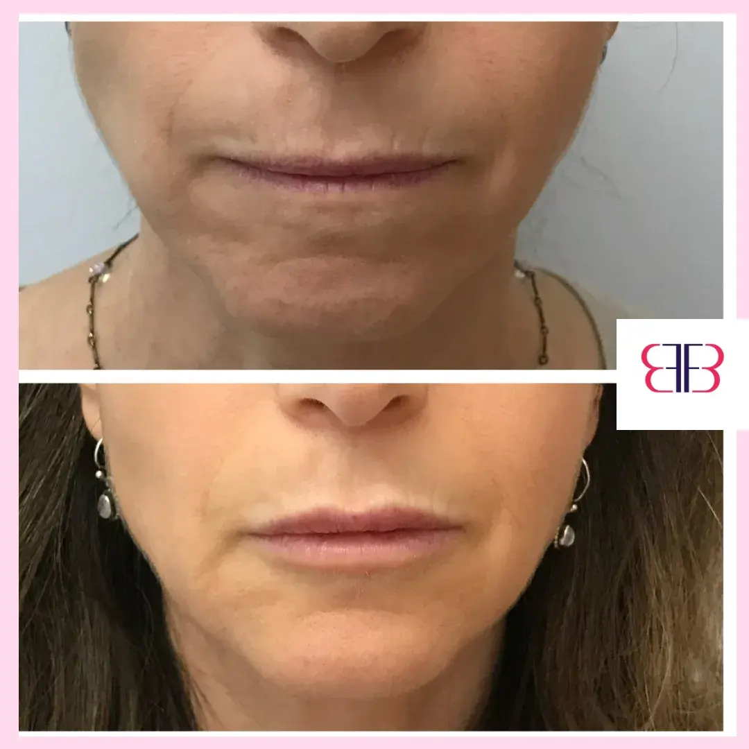 lip filler before and after