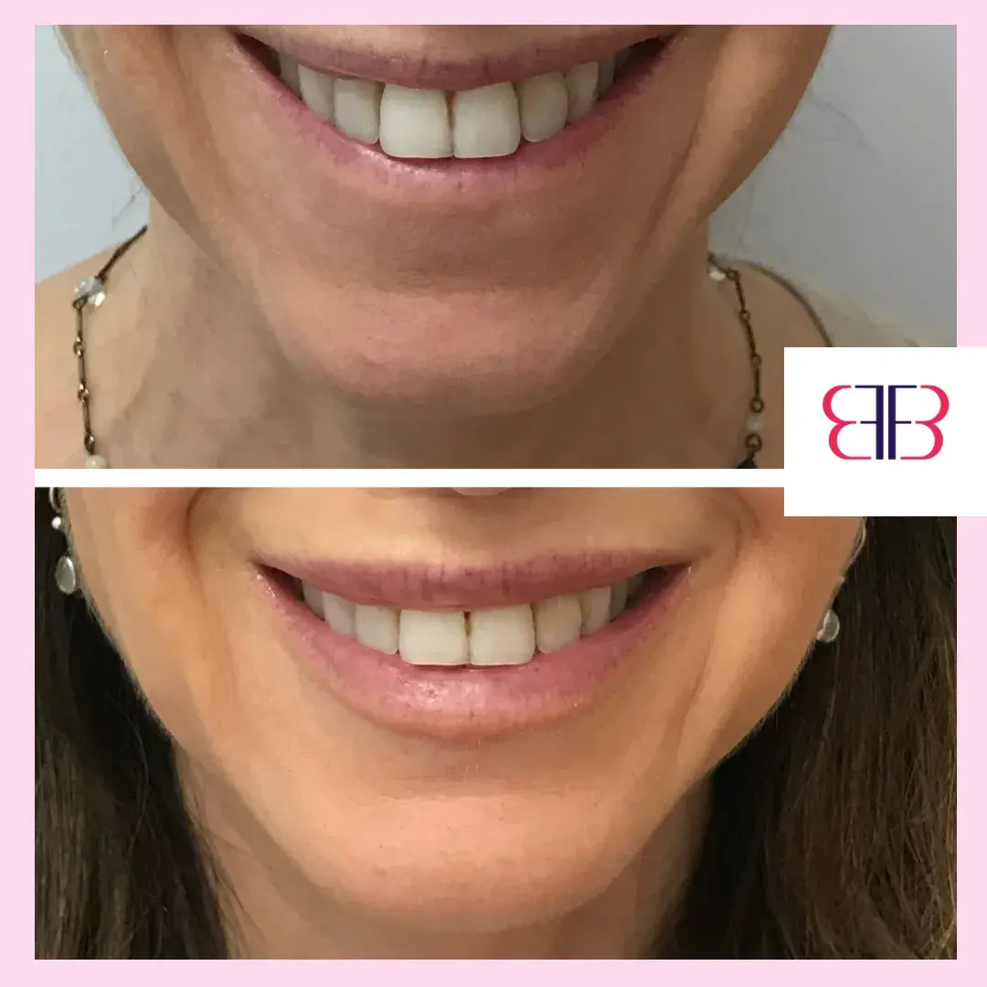 lip filler before and after