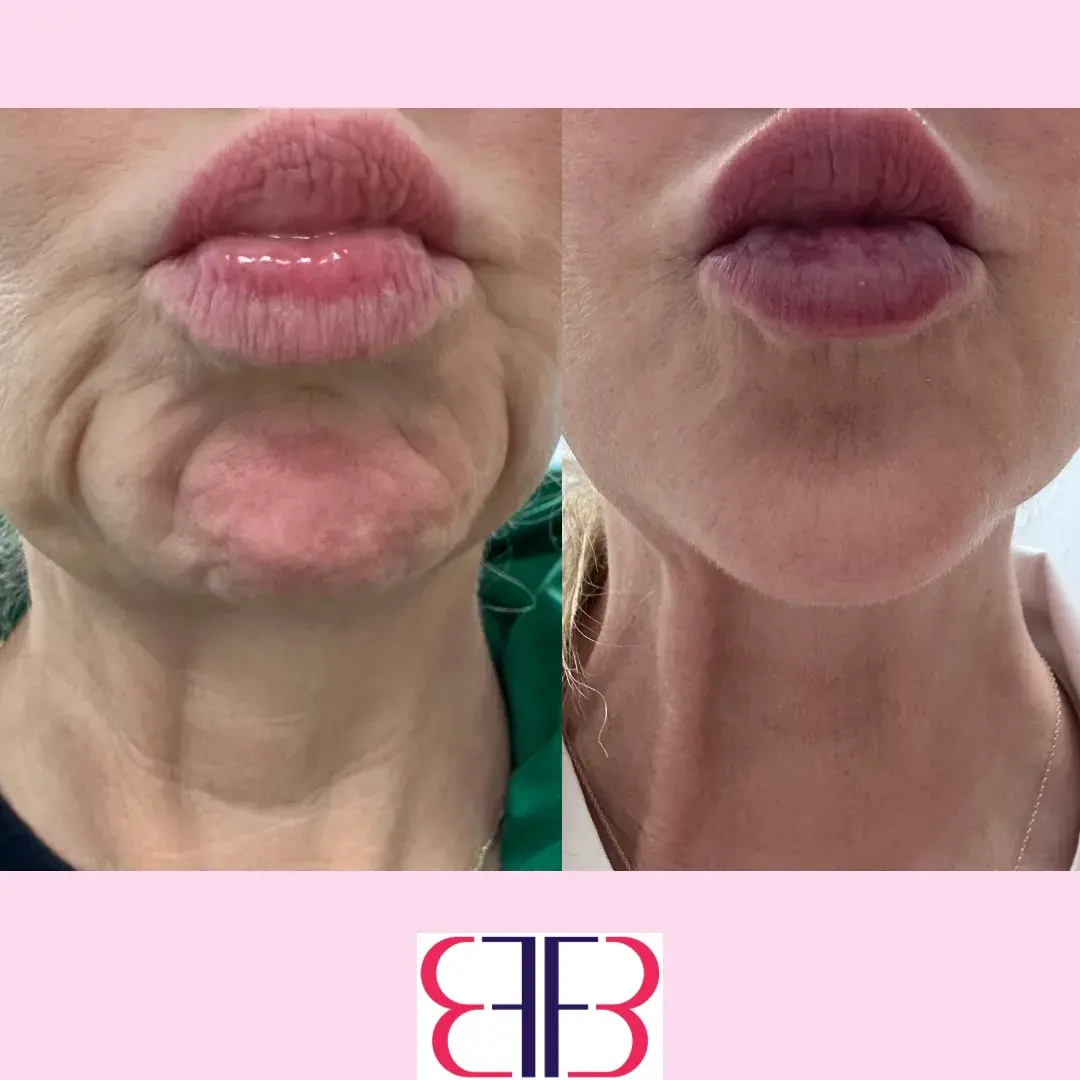 lip filler before and after