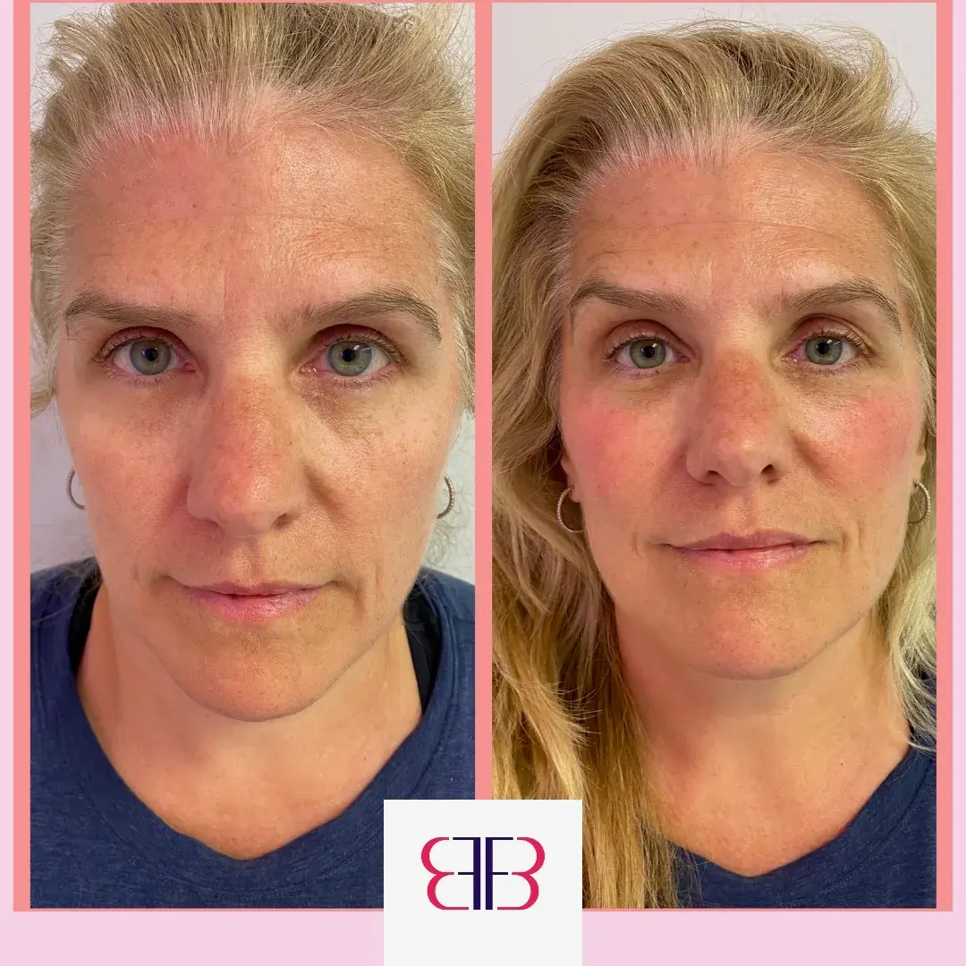 skin tone and texture before and after