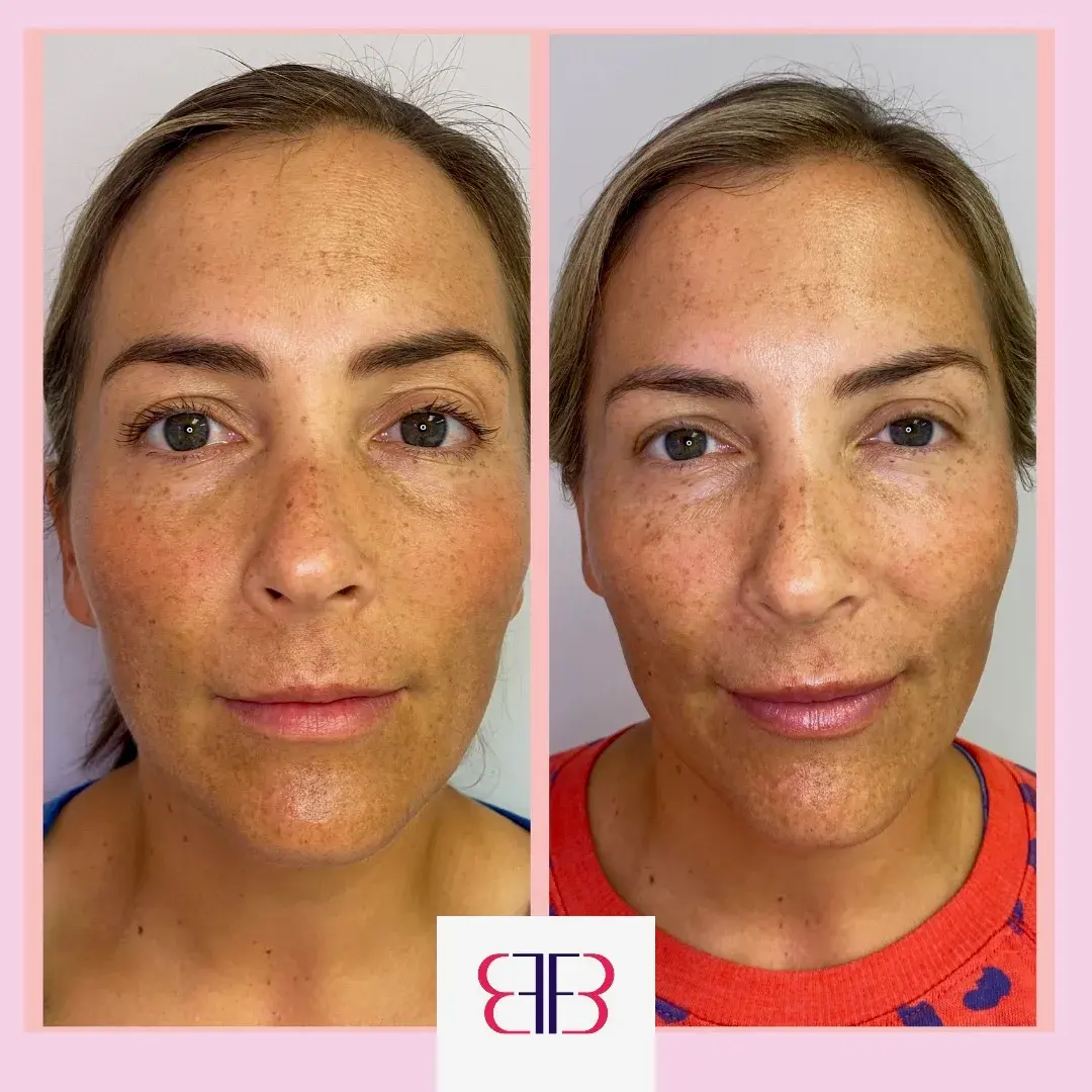 skin tone and texture before and after