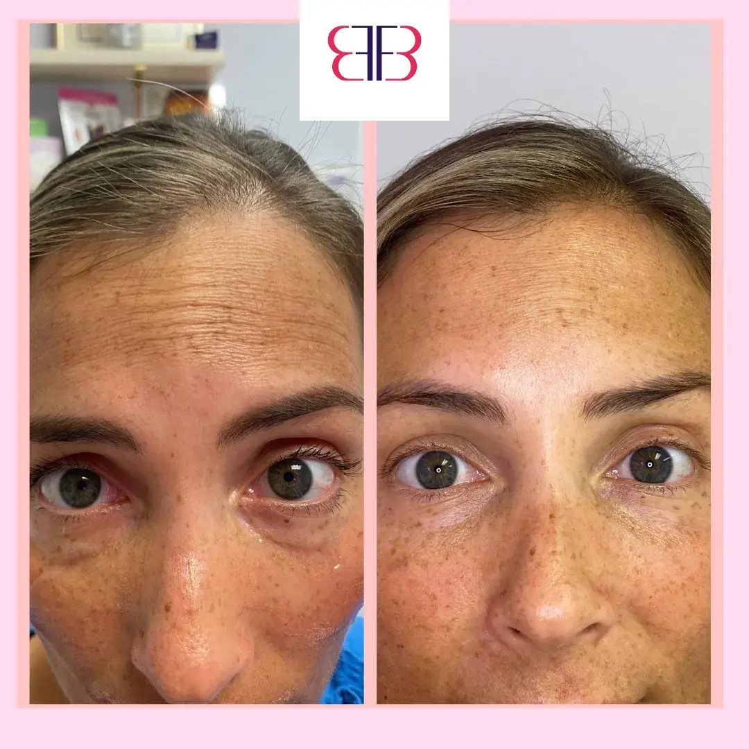 skin tone and texture before and after