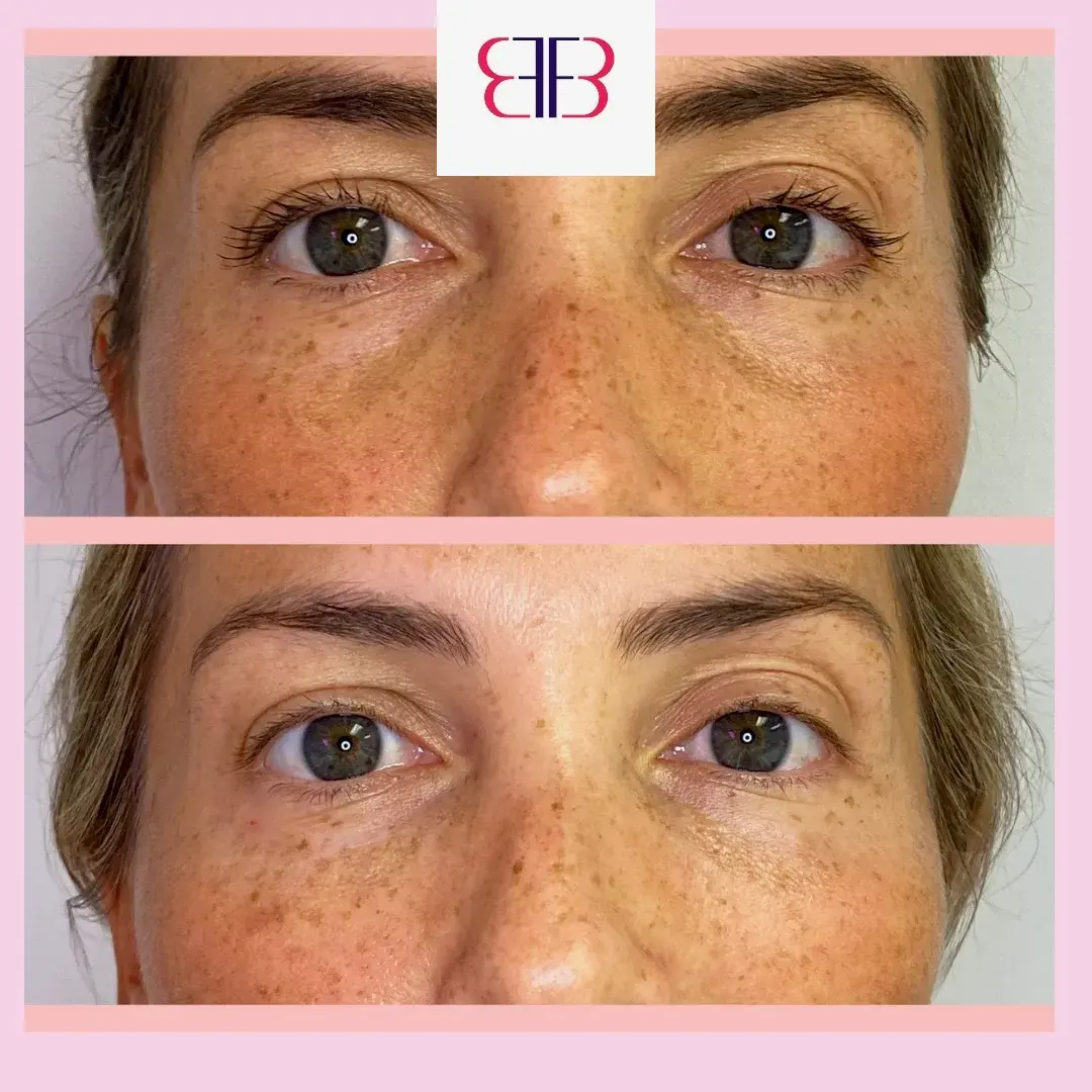 under eye filler before and after