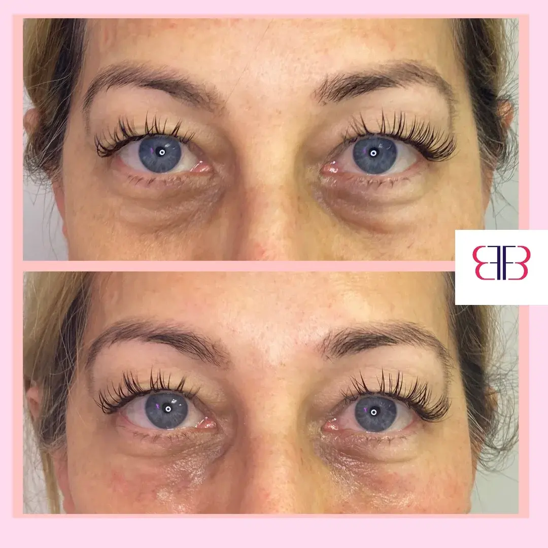under eye filler before and after