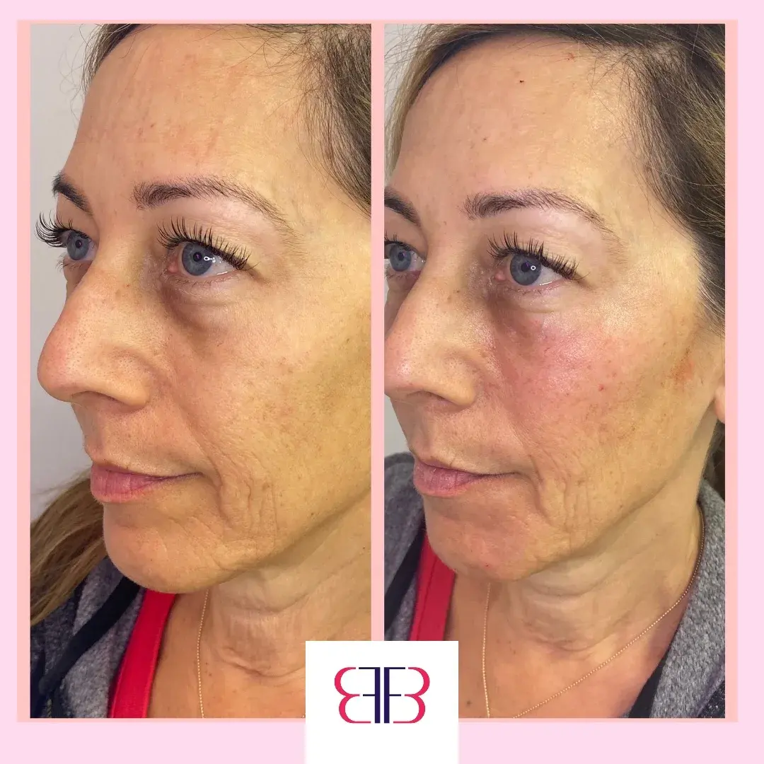 under eye filler before and after