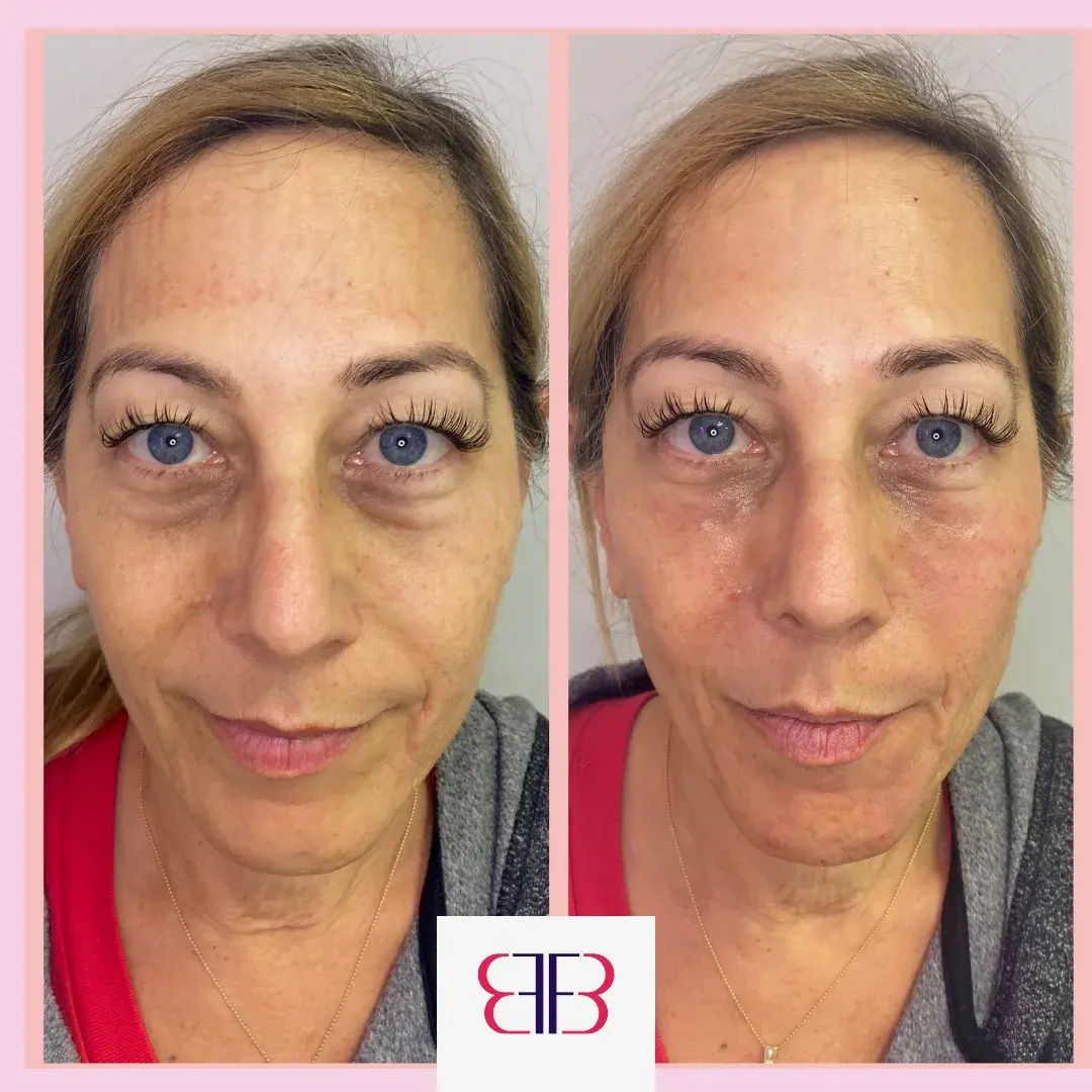 under eye filler before and after
