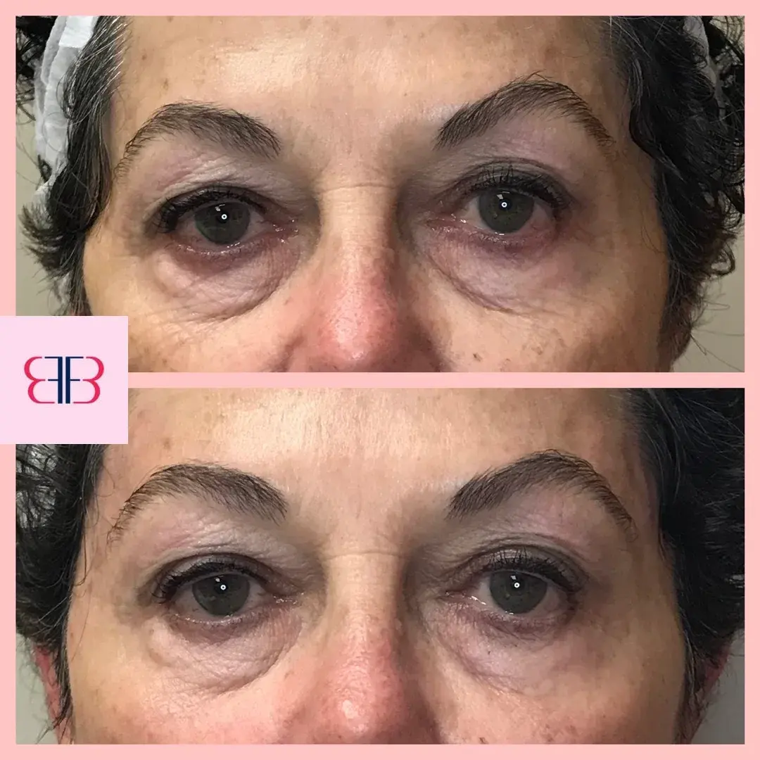 under eye filler before and after