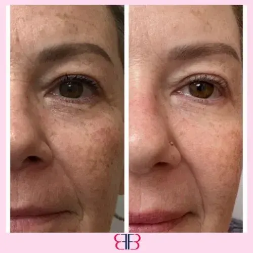 under eye filler before and after