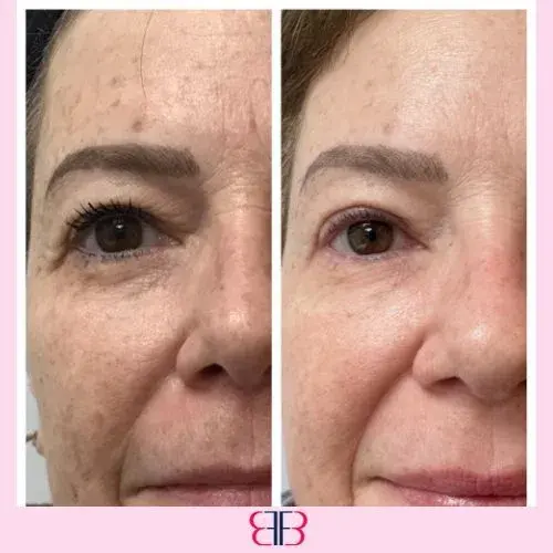under eye filler before and after