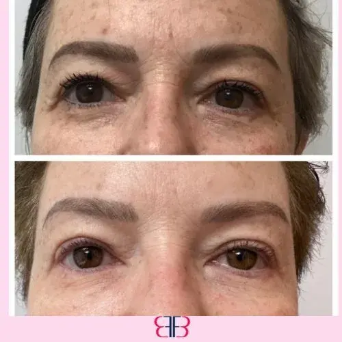 under eye filler before and after