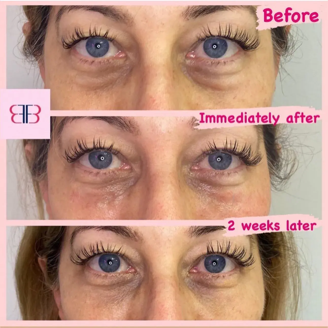 under eye filler before and after