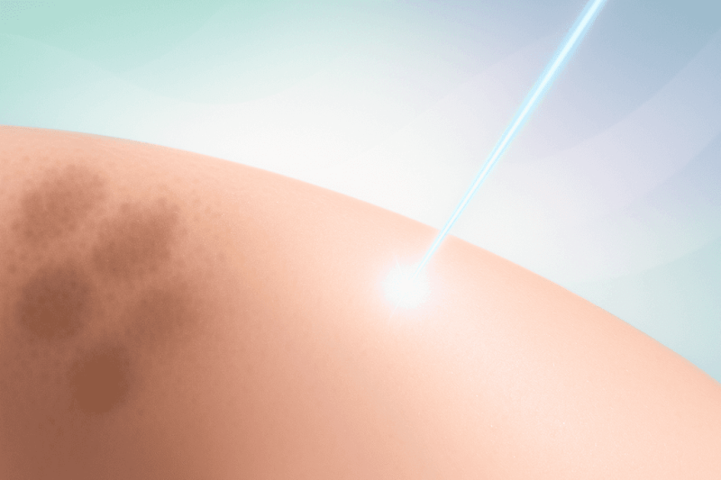 NOUVAderm laser for stubborn pigment reduction